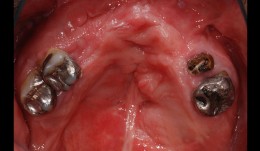 Reconstruction of the edentulous upper jaw of cleft patient