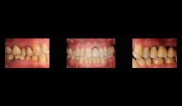 Rehabilitation of masticatory performance in a patient with periodontitis