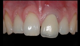 Replacement of central incisor with implant and closure of diastema