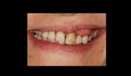 Replacement of poorly fitting removable prosthesis and simultaneous orthodontic treatment