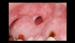 Total reconstruction after closure of maxillary sinus fistula