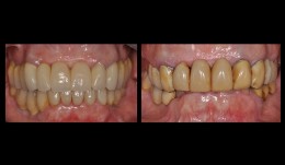 Unesthetic reconstructions - a challenging case