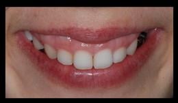 Upper anterior esthetic crown lengthening