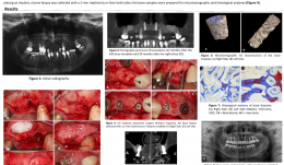 BONE FORMATION AT 12 MONTHS AND 20 MONTHS AFTER SINUS ELEVATION SURGERY WITH INORGANIC BOVINE BONE—A SPLIT-MOUTH CASE REPORT WITH MICROTOMOGRAPHIC AND HISTOLOGICAL EVALUATION