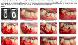 MANDIBULAR CLASS II FURCATION REGENERATION USING A COLLAGEN MEMBRANE ASSOCIATED WITH ANORGANIC BOVINE BONE PLUS PORCINE COLLAGEN—A CASE REPORT WITH TOMOGRAPHIC EVALUATION