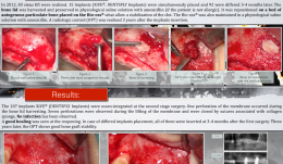 BONE LID FOR CLOSING MAXILLARY SINUS WINDOW DURING SINUS GRAFTING WITH ANORGANIC BOVINE BONE MINERAL (ABBM) AND AMOXICILLIN—3-YEAR FOLLOW-UP OF 83 CASES