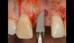 Implant timing