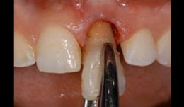 Alveolar ridge preservation