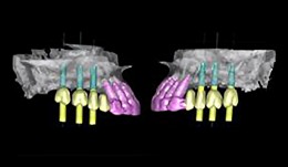 Implant planning