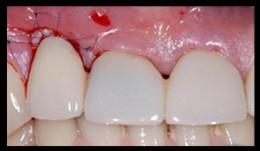 Pre- and peri-operative soft tissue management