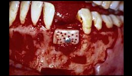 Major bone regeneration procedures