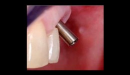 Postoperative Care and Complications
