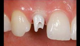 Choice of abutment