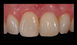 Prosthetics: Single crowns