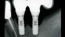 Biologic Complications - Peri-implantitis