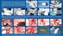 ACHIEVING A MORE EFFICIENT CONTACT SURFACE BETWEEN A BLOCK BONE AND RECIPIENT AREA USING A 3D STEREOLITHOGRAPHY (SLA) MODEL OF A JAW FRAGMENT IN ADJUSTING A HUMAN BONE BLOCK TO THE RESIPIENT AREA AND  TIME SAVING DURING OPERATION