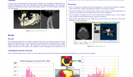 DEVELOPMENT OF A HELICOIDAL CT-BASED COMPUTER TOOL TO ESTIMATE BONE DENSITY AROUND DENTAL IMPLANTS