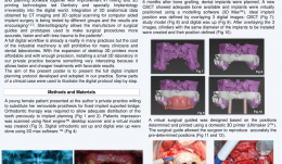 DIGITAL IMPLANT PLANNING WITH 3-D PRINTERS AND CBCTS IN GUIDED SURGERY AND BONE GRAFT PROCEDURES
