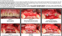 INCREASE OF TRANSVERSE VOLUME USING GUIDED BONE REGENERATION (GBR) WITH ANORGANIC BOVINE BONE MINERAL (ABBM) IN AESTHETIC AREAS AFTER AUTOGENOUS BONE GRAFT—A CASE REPORT