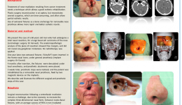 REHABILITATION OF A PATIENT WITH NOSE MUTILATION RESULTING FROM CARCINOLOGIC SURGERY USING EXTRAORAL FIXTURES AND EPITHESIS