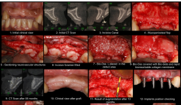RIDGE AUGMENTATION BY APPLYING DEPROTEINISED BOVINE BONE MINERAL (DBBM) AND BIORESORBABLE MEMBRANE—A CASE REPORT