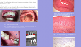 ENDOIMPLANTIASIS: DESCRIPTION OF THE CLINICAL ASPECT, RADIOGRAPHIC, HISTOLOGIC, IMMUNOHISTOCHEMICAL AND MICROBIOLOGICAL – A CASE SERIES