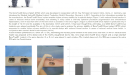 IN VITRO ASSESSMENT OF PRIMARY STABILITY OF BONE TRUST[TM] SINUS IMPLANT DESIGN—A PRELIMINARY STUDY