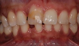 Central incisor implant