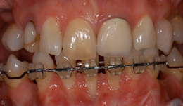 An interdisciplinary case (orthodontics, surgery and prosthetics)