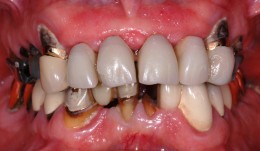 Complex rehabilitation with a overdenture