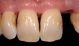 Immediate Implant placement in the esthetic area