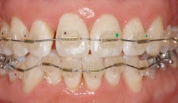 Complete periodontal treatment by Dr. Sanz Martin