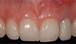 Hopeless lateral incisor in a young patient