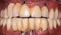 Complete rehabilitation of a cleft patient