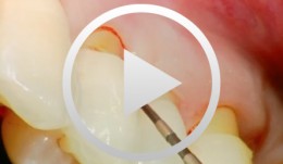 YAG Laser Applications