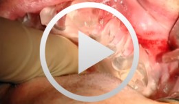 Sinus Bone Augmentation with PRP