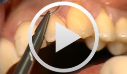 Esthetic Periodontal Treatment with Microsurgical