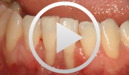 Verbreiterung der attached keratinisierten Gingiva durch ein freies Schleimhautimplantat