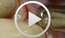 Access-Flap for Treatment of Aggressive Periodontitis