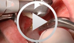 Implant-borne Immediate Prothesis on Laser-Welded Bar