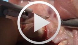 Bone Transfer