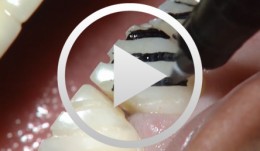 Ãsthetische Versorgung von Frontzähnen mit keramischen Laminate Veneers