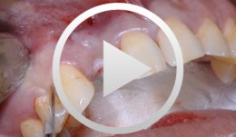 Implantologische Versorgung mit Soft- und Hard-Tissue-Management