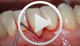 Connective tissue graft for recession defect coverage and vertical osseous defect in the anterior mandible