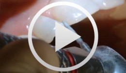 Incremental layering composite restoration in the anterior maxilla