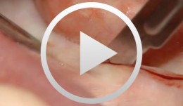 Immediately loaded implant restorations in the edentulous mandible