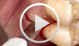 Gesteuerte Knochenregeneration mit Membrantechnik im OK-Seitenzahnbereich. Insertion eines Implantats - Der komplette Fall