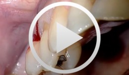 Piezo Surgery Technique for Alveolar Ridge Augmentation with Sinus Lift