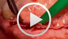 Treatment of the Edentulous Mandible with an Immediately Loaded Screw-retained Fixed Restoration - The entire case