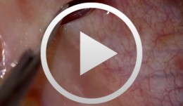 Regenerative Procedures for Optimized Esthetics at Tooth 11